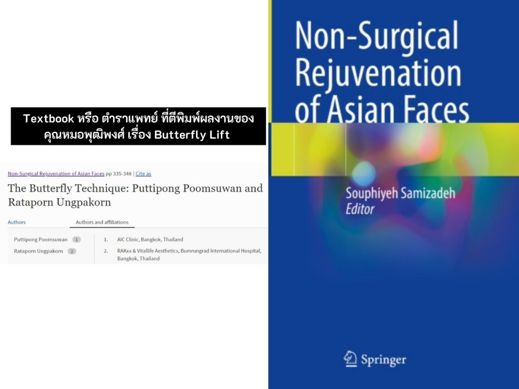 ผลงานการคิดค้นเทคนิคการฉีดฟิลเลอร์ Butterfly Lift ของคุณหมอพุฒิพงศ์