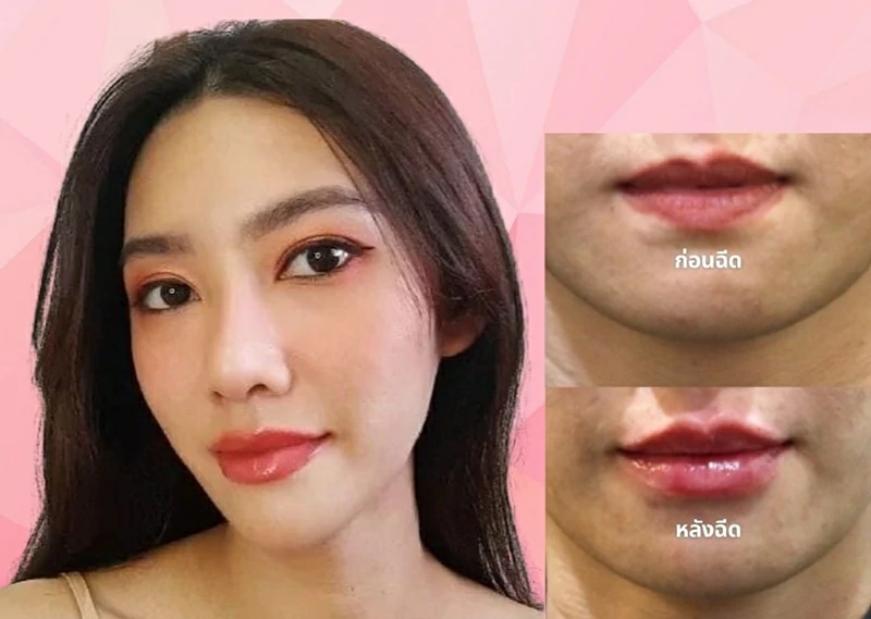 ฉีดปากกระจับที่ไหนดี