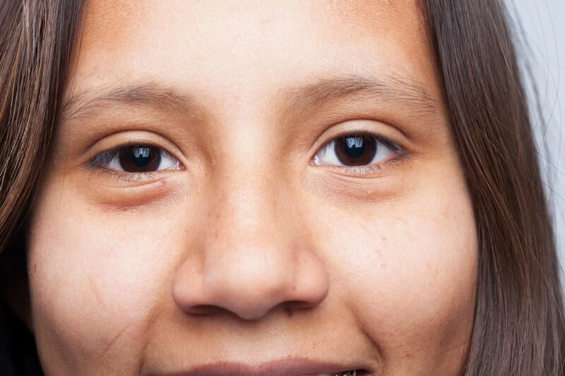 ฉีดฟิลเลอร์ใต้ตาที่ไหนดี