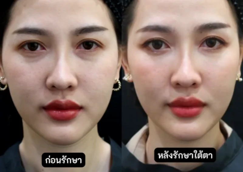 ฉีดฟิลเลอร์ใต้ตาที่ไหนดี